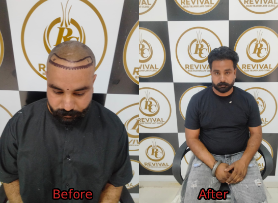Hair Transplant Result 2