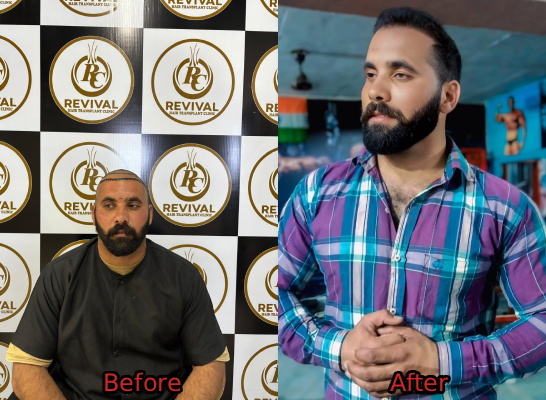 Hair Transplant Result 3